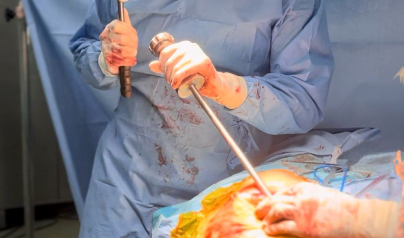 Hip Replacement Service Hip Replacement Service