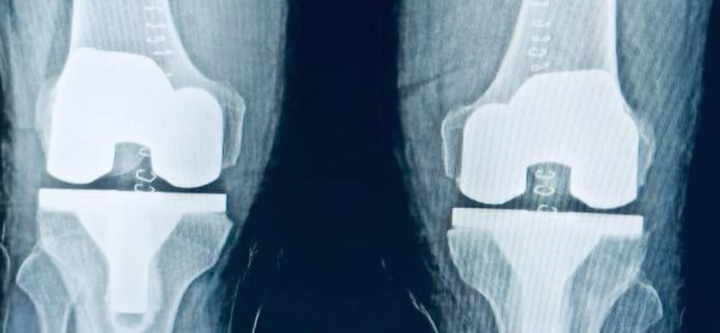 Knee Replacement (1)