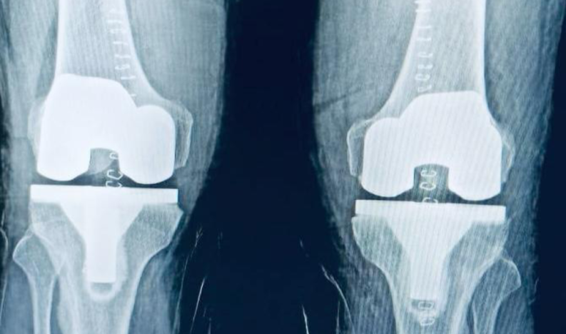 Knee Replacement (1) Knee Replacement (1)