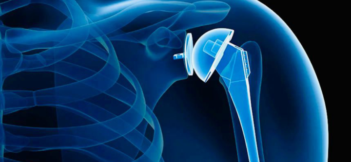 Shoulder Replacement Service