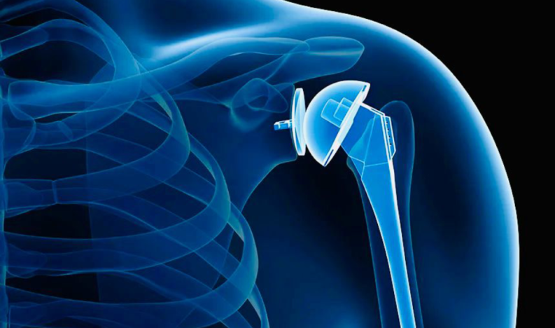 Shoulder Replacement Service Shoulder Replacement Service