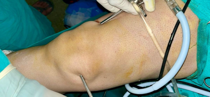 Knee Arthroscopy Services