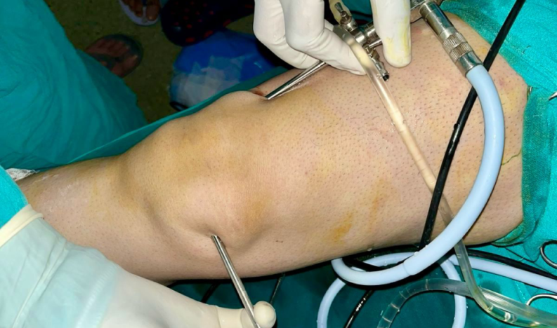 Knee Arthroscopy Services Knee Arthroscopy Services