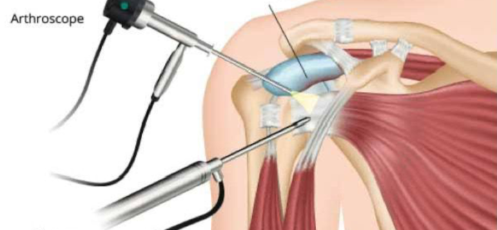 Shoulder Arthroscopy Service