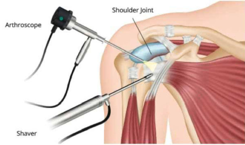 Shoulder Arthroscopy Service Shoulder Arthroscopy Service