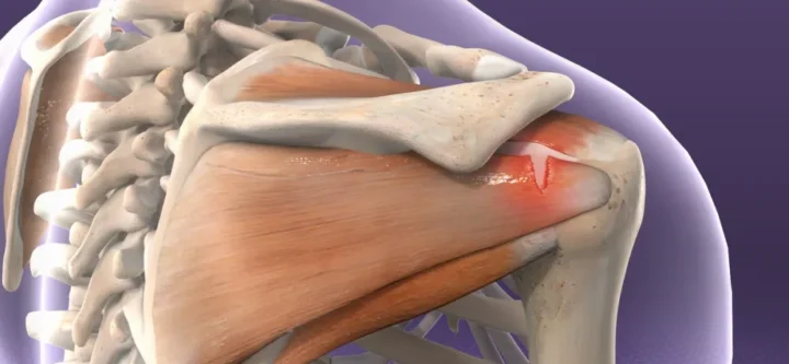 Rotator Cuff Tear