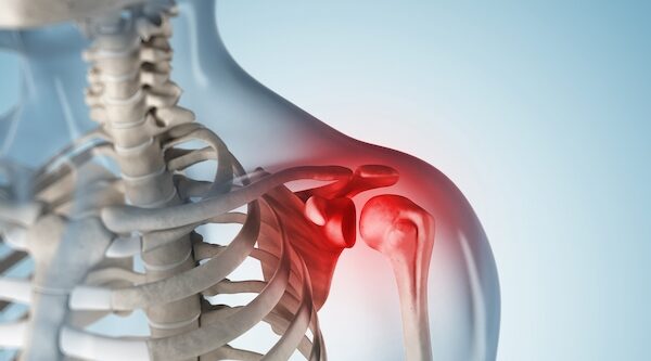 Impingement Sendromu