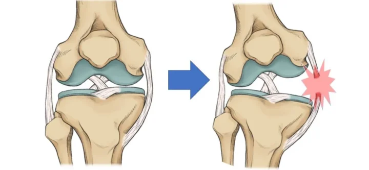 MCL-injury