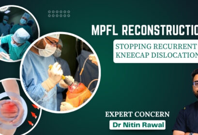 MPFL Reconstruction