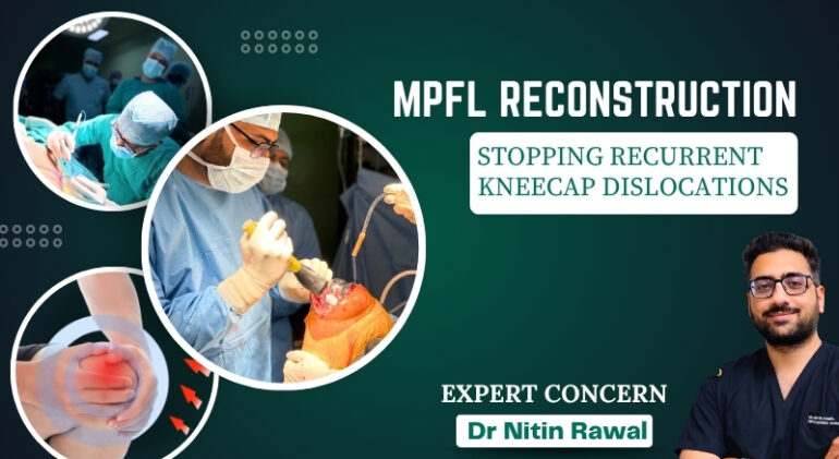 MPFL Reconstruction